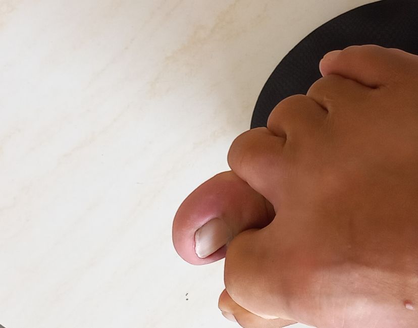 Nft PINCHED THUMB